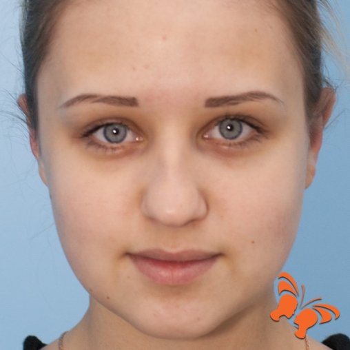 Отопластика после