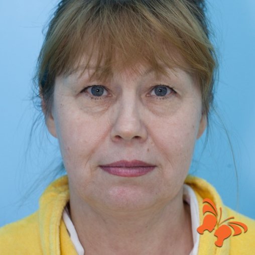 Подтяжка лица до