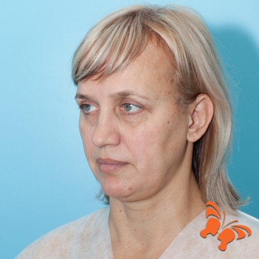 Подтяжка лица до