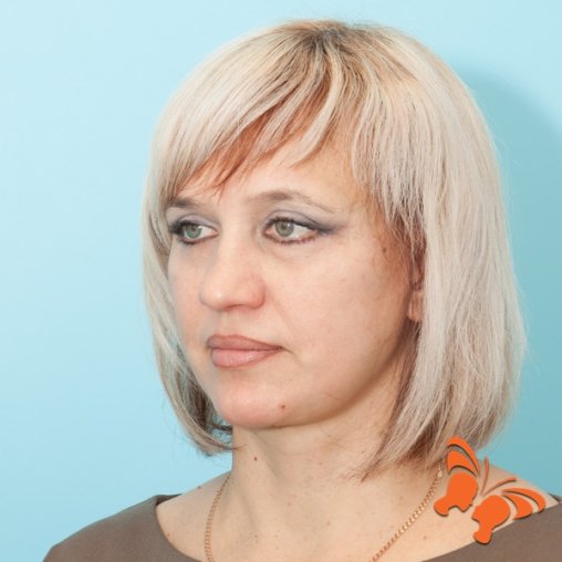 Подтяжка лица после
